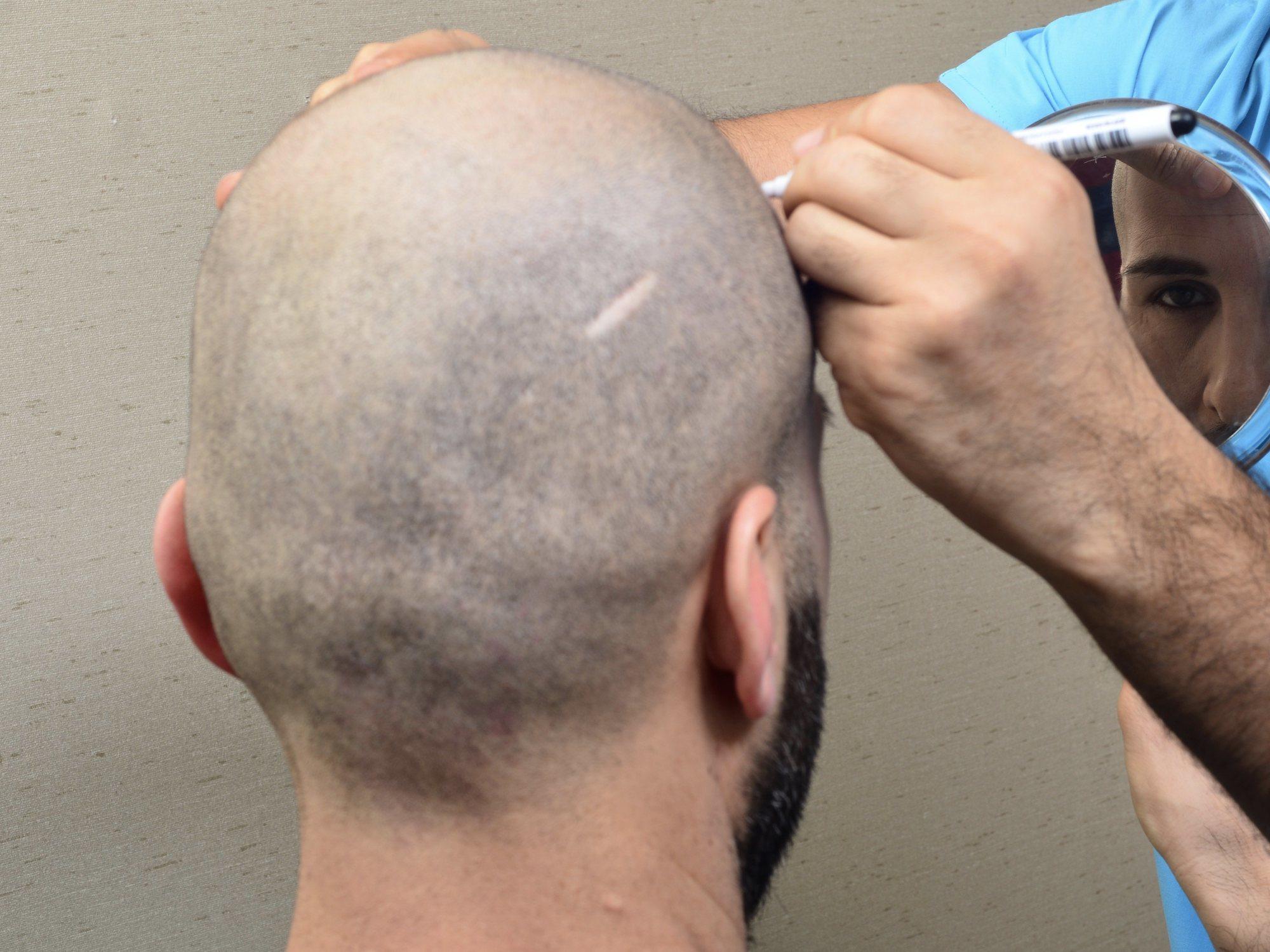 Hair Transplant in Dubai