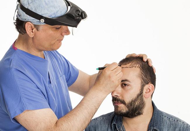 Hair Transplants in Dubai