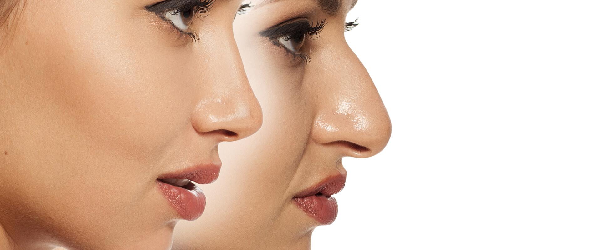 Rhinoplasty Dubai