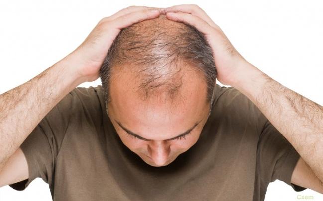 Hair transplant in Dubai