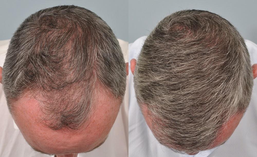 Hair transplant in Dubai