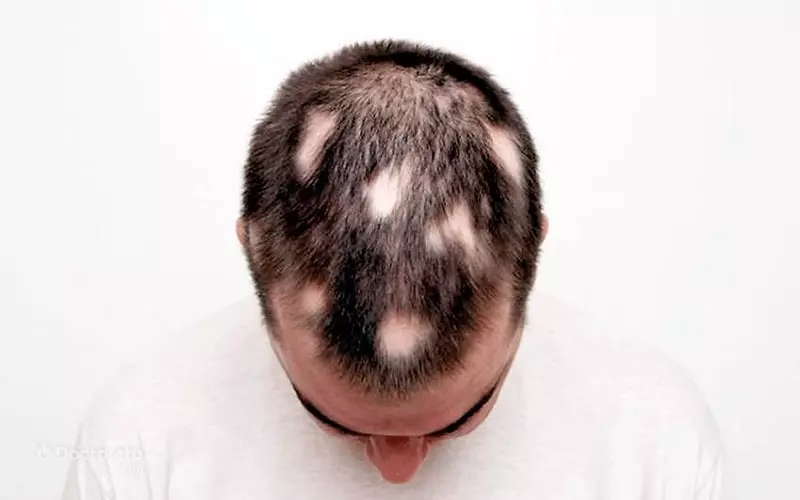 Hair transplant in Dubai