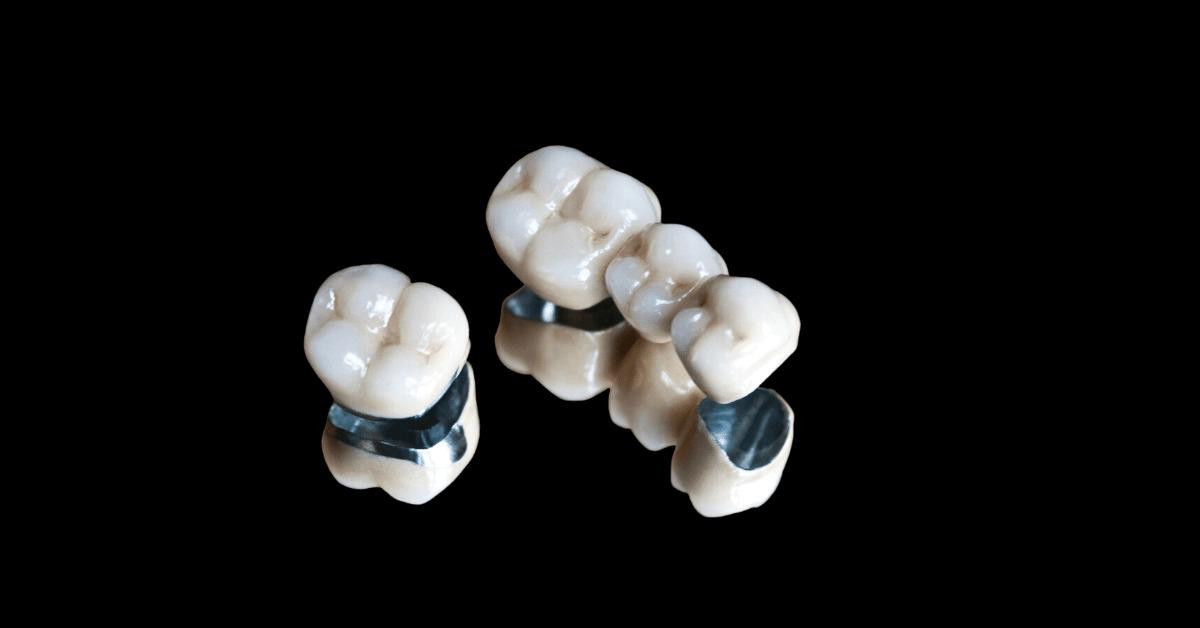 Dental Crowns and Bridges in Dubai