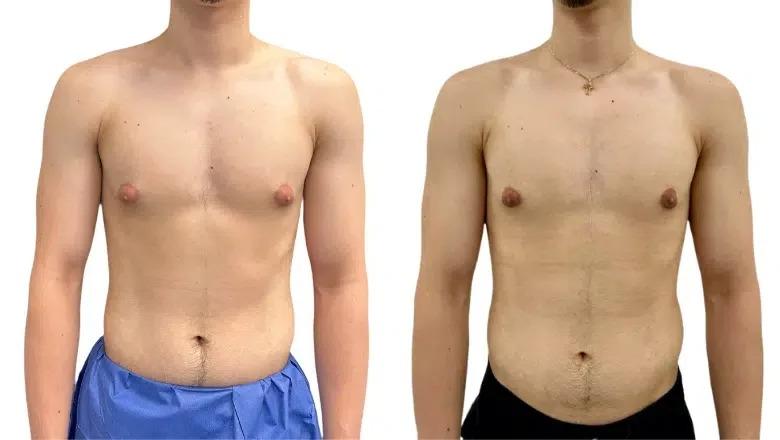 Gynecomastia