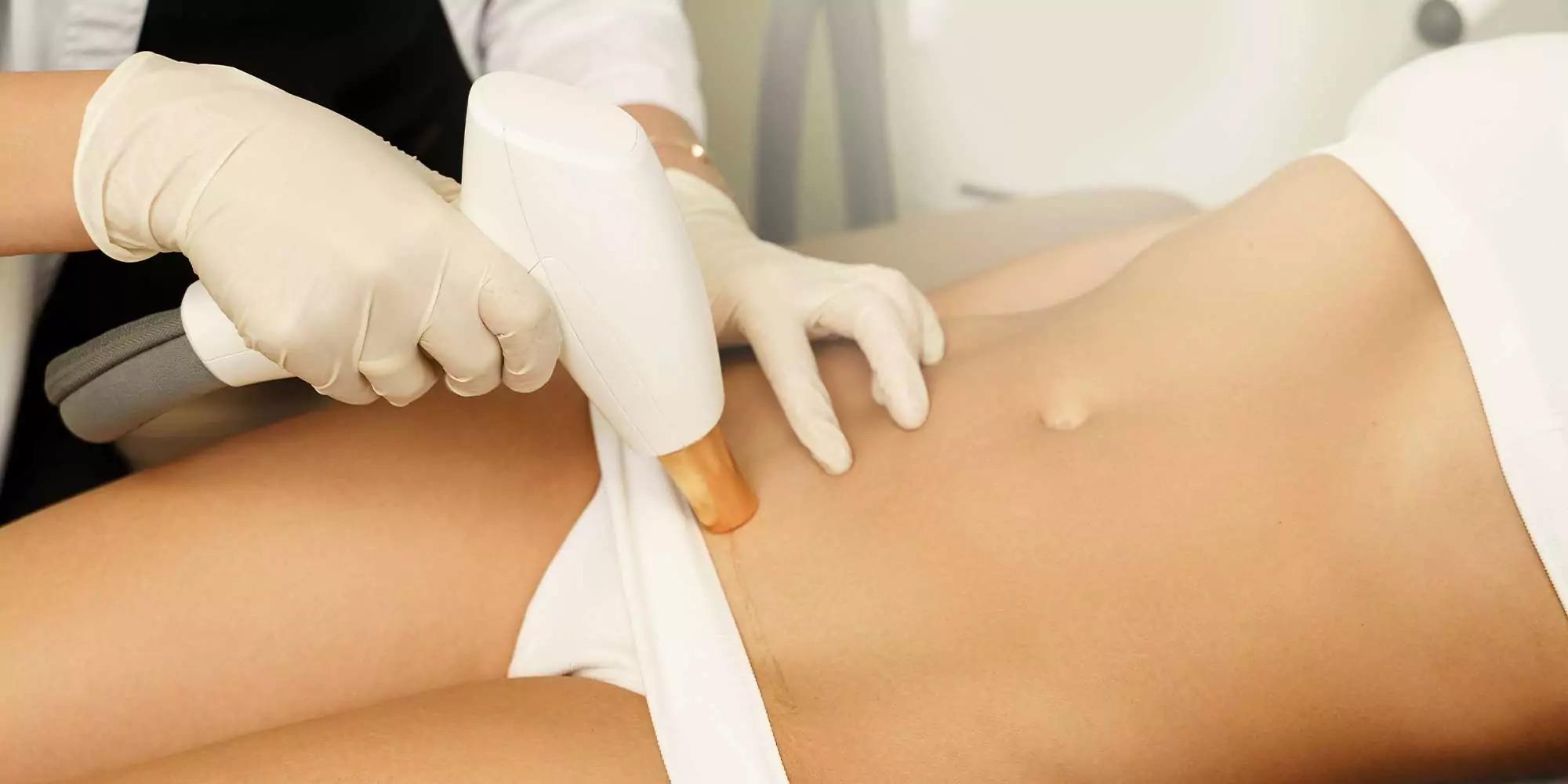 Laser Stretch Marks Treatment