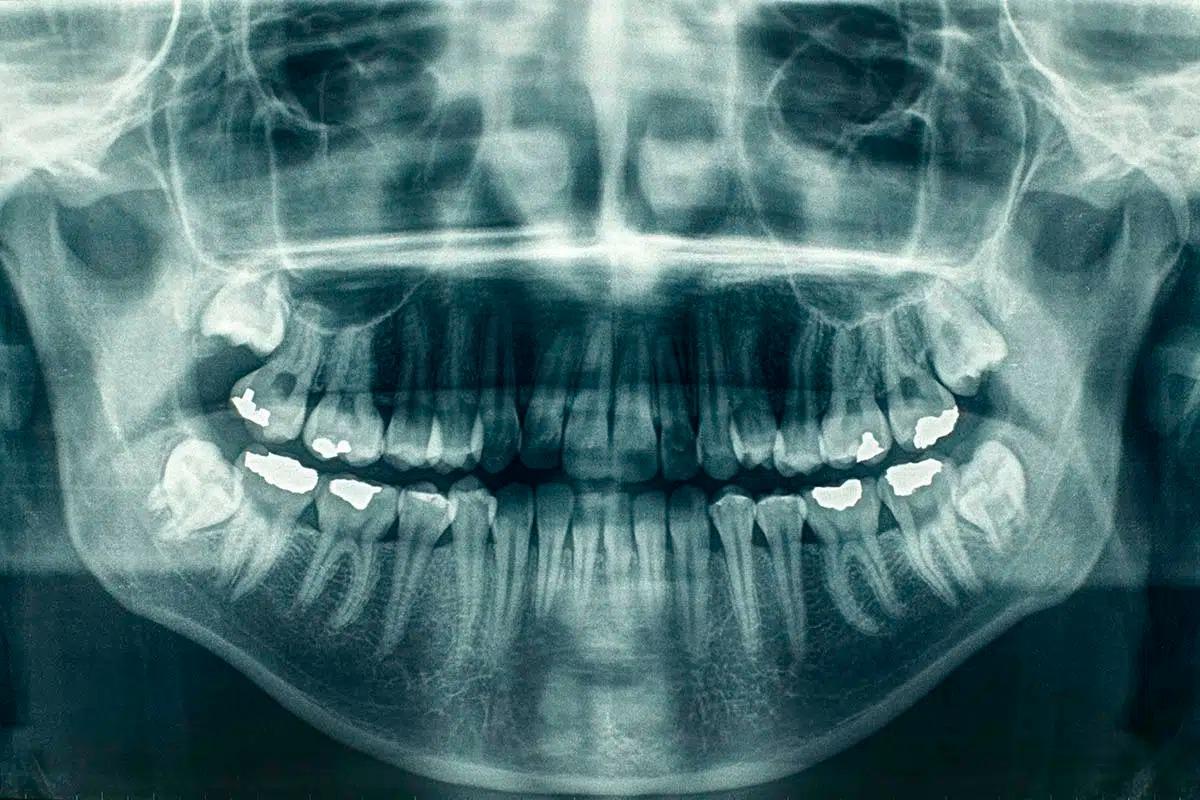 Panoramic Dental X-Ray