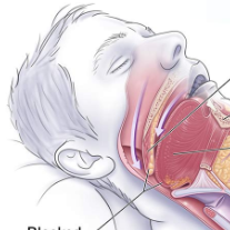 Sleep Apnea